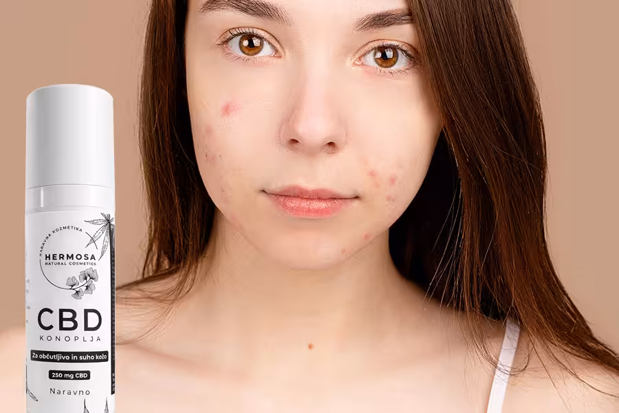 krema za akne in dekle z aknami